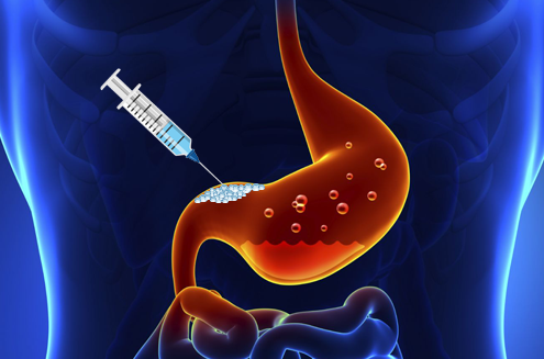 Gastric_Botox-1