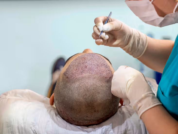 Hair-transplant-surgery-732x549-thumbanil