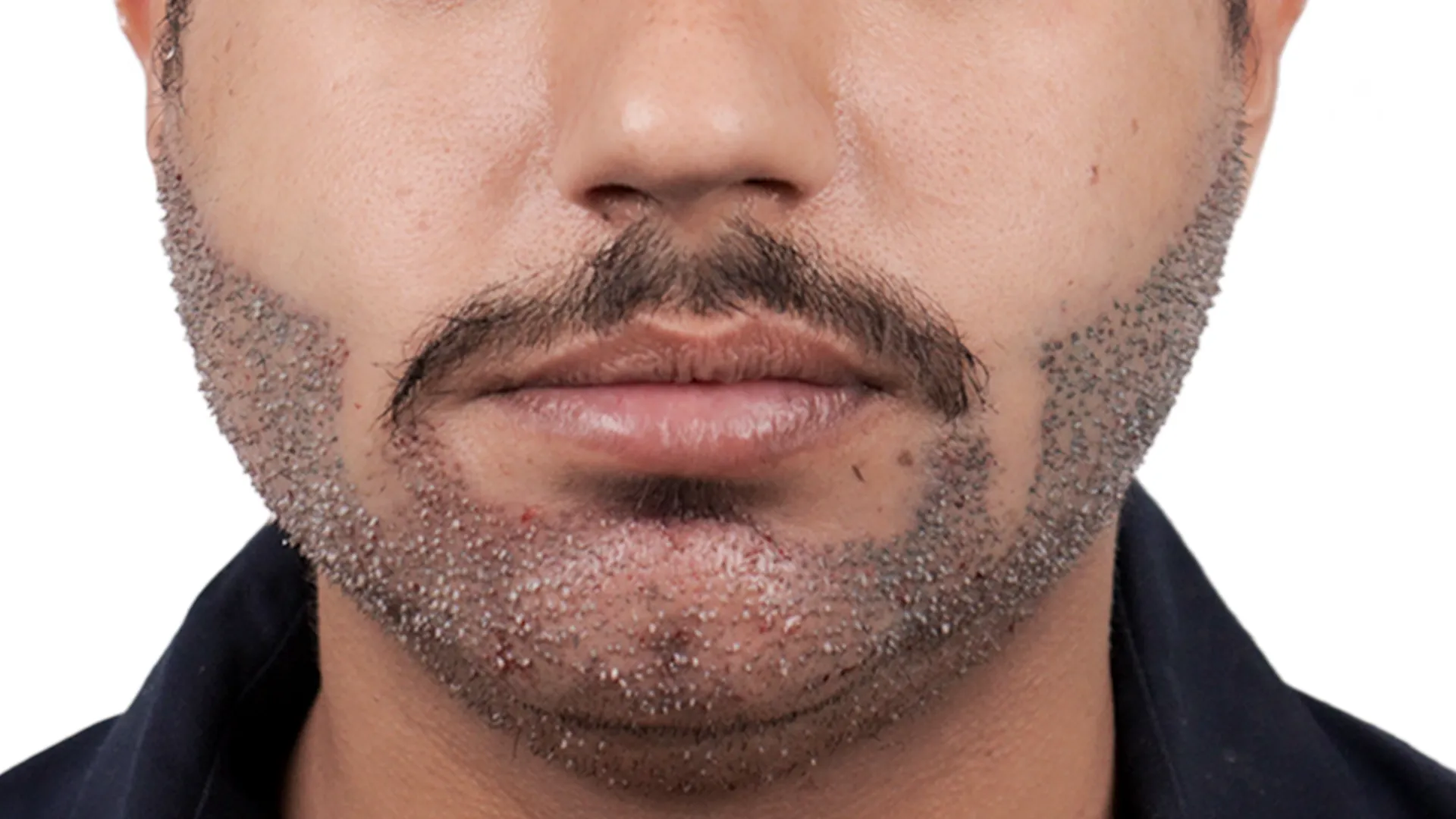 Implantation-of-Hair-Graft