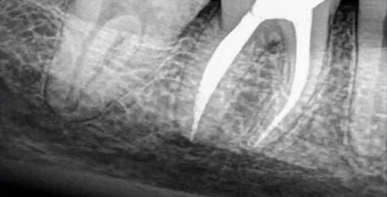 endo-ba01-after-treatment-vitrin-clinic