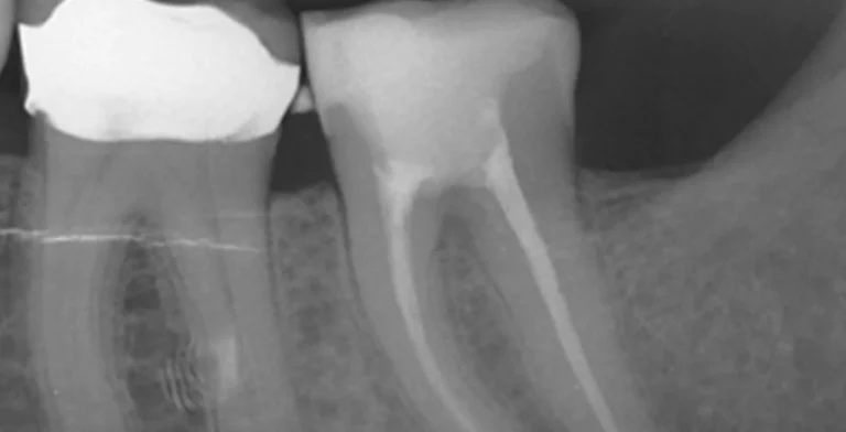 endo-ba02-after-treatment-vitrin-clinic