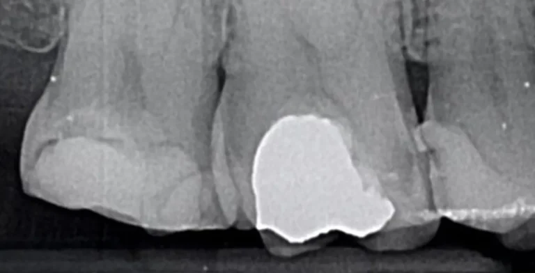 endo-ba03-before-treatment-vitrin-clinic