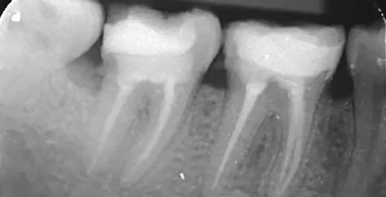 endo-ba04-after-treatment-vitrin-clinic