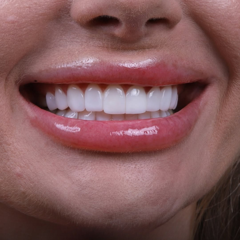 hollywood smile (20)