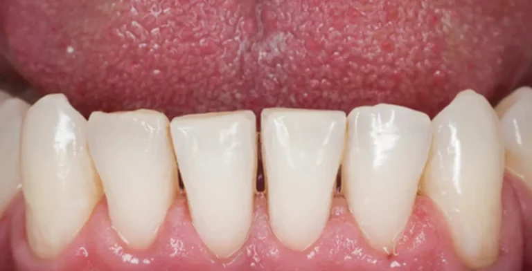 periodontics-ba02-after-treatment-vitrin-clinic