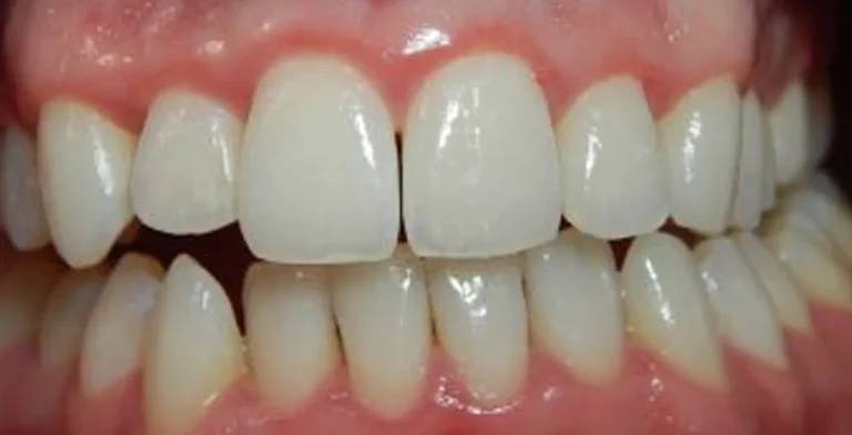 periodontics-ba03-after-treatment-vitrin-clinic