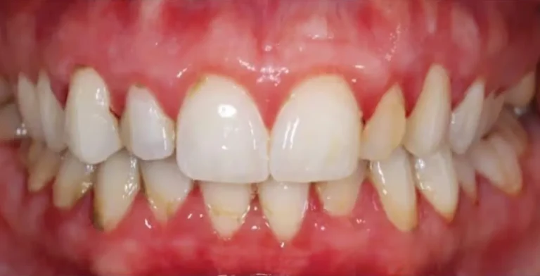 periodontics-ba04-before-treatment-vitrin-clinic