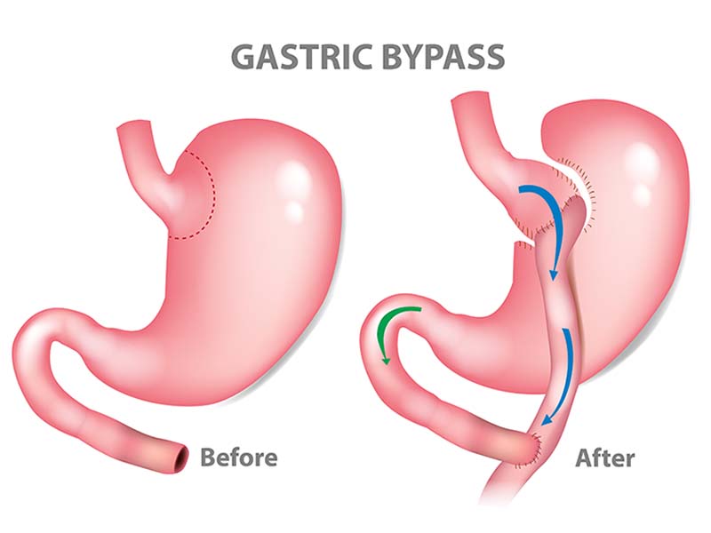 stock-vector-gastric-bypass-surgery-rny-roux-en-y-mini-gastric-bypass-1136825978