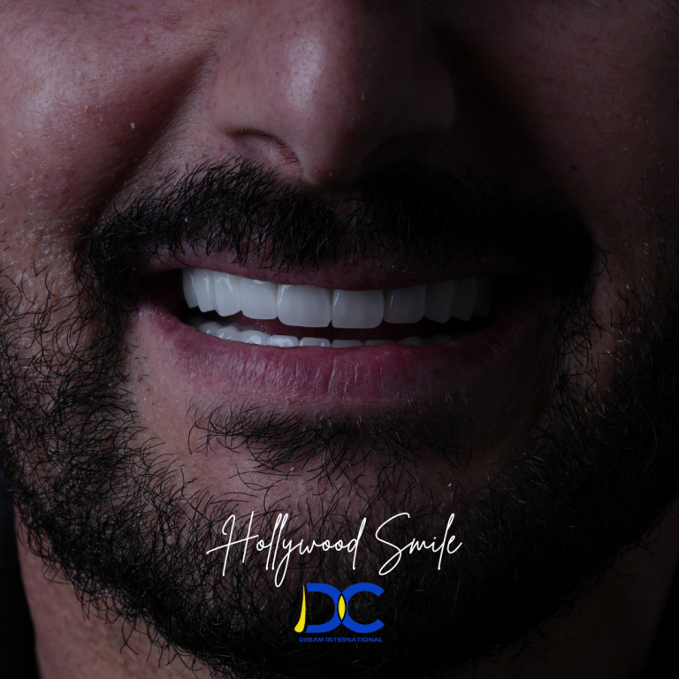 Hollywood Smile (13)