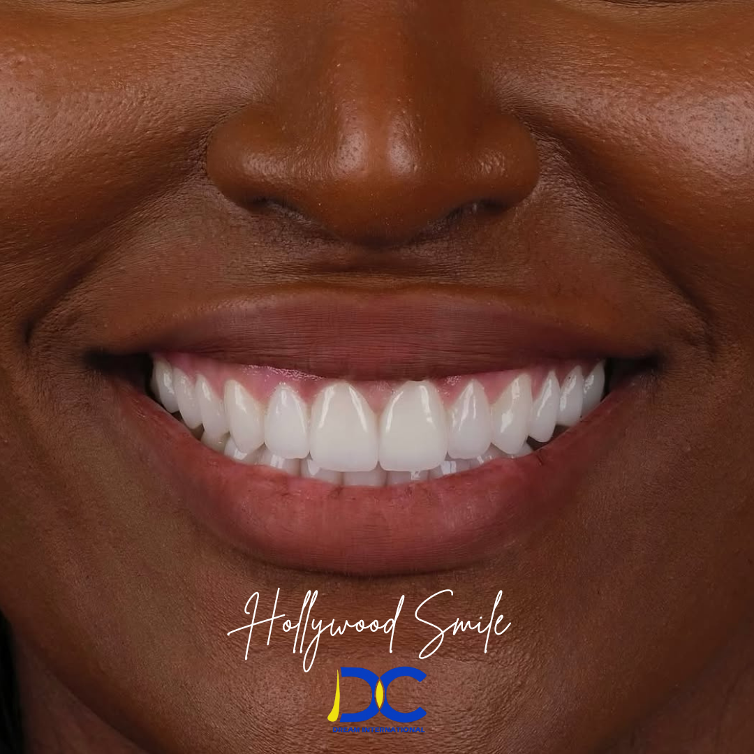 Hollywood Smile (37)