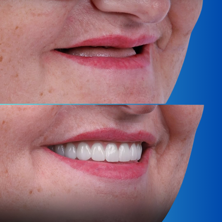 hollywood smile (38)