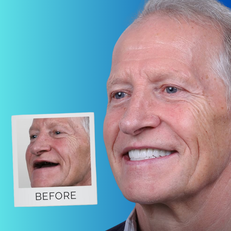 hollywood smile (40)